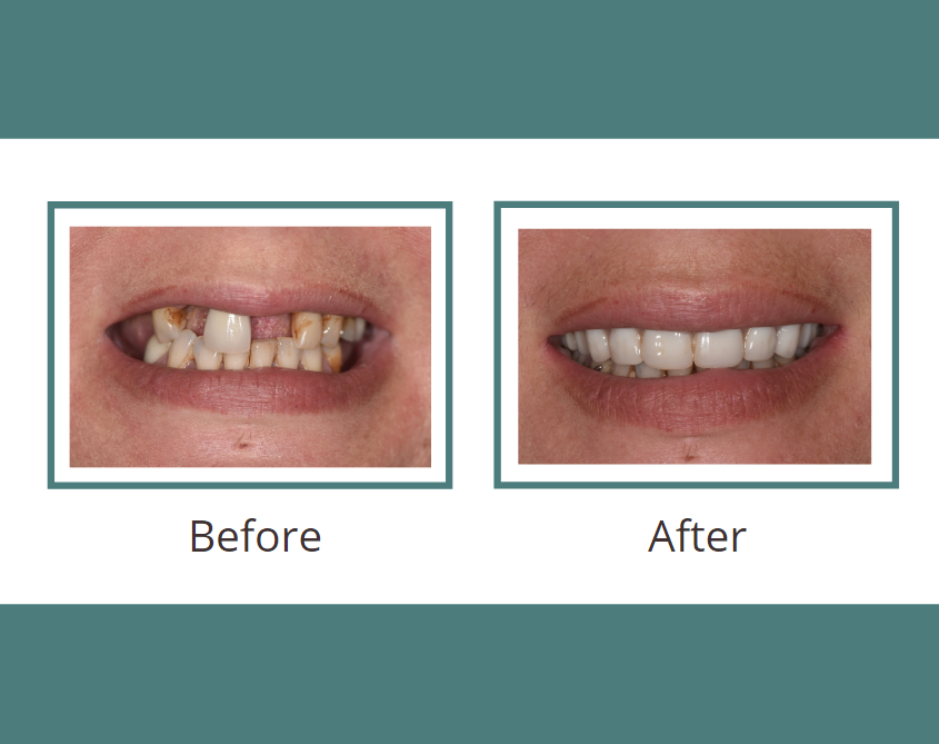 AACD Give Back a Smile before and after picture
