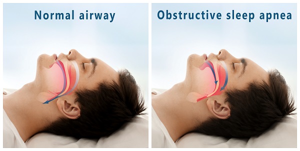 airway obstruction caused by sleep apnea in Greece NY