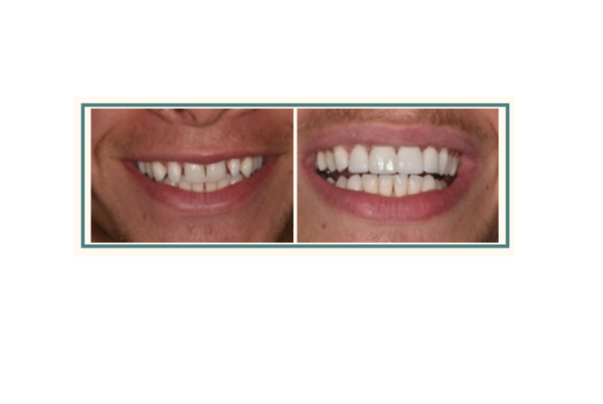 Before and after image showing a young man's rejuvenated smile after cosmetic dentistry in Rochester