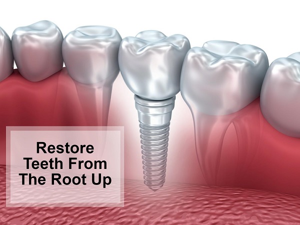 Dental implants to restore your teeth