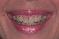 Before closeup photo - Rochester cosmetic dentistry