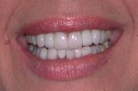 Final after pictures - Rochester Smile Makeover with porcelain veneers, Empress crowns
