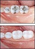 Fairport NY Cerec Porcelain Fillings