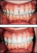 Cerec Porcelain Crowns Fairport NY