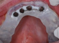 Computer Generated Implant Surgery Guide 1 - Rochester Dental Implants