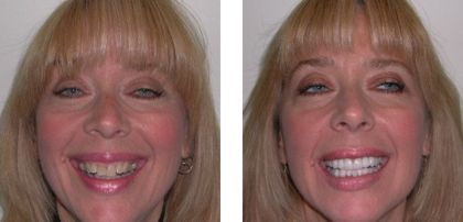 Before & After Rochester Smile Makeover Photos - Kim