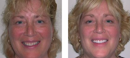 Judy Before After Photo - Fairport NY Cosmetic Dentistry