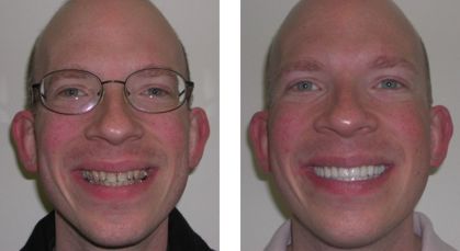 Shawn Before After Photo - Brighton Cosmetic Dentistry