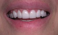 Gummy smile reconstruction after photo - Fairport Porcelain Veneers