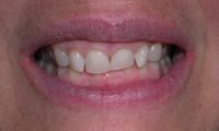 Before closeup photo gummy smile - Laser Cosmetic treatment