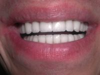 Shawn after photo closeup - Final porcelain veneers and cosmetic restorations