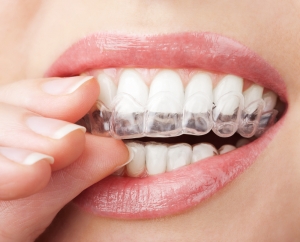 A model adjusts a clear Invisalign aligner tray | Greece, NY