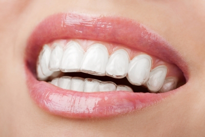 Invisalign aligners