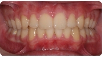 A patient after care from the Center for Cosmetic Dentistry