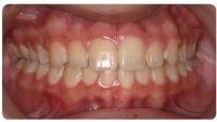 After Orthodontic care from the Center for Cosmetic Dentistry