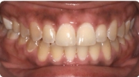 Improving patient bite after care from the Center for Cosmetic Dentistry