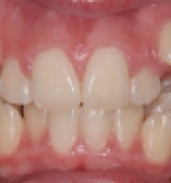 Before photo of patient with teeth crowding