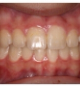 After Orthodontic care from the Center for Cosmetic Dentistry