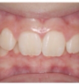 Before Orthodontic care from the Center for Cosmetic Dentistry