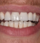 Closing spaces with porcelain veneers