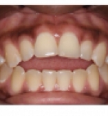 Improving patient bite before photo