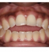 Improving patient bite before photo