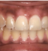 Improving patient bite after care from the Center for Cosmetic Dentistry