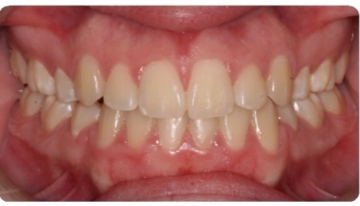 After care from Dr. Sussman and Dr. Pogal at the Center for Cosmetic Dentistry