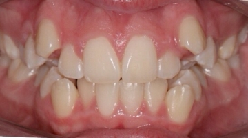 Before photo of patient with teeth crowding