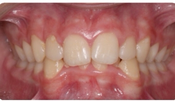A patient before care from the Center for Cosmetic Dentistry