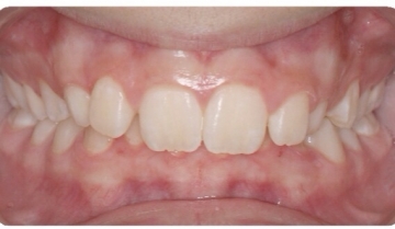 Before Orthodontic care from the Center for Cosmetic Dentistry