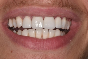 Closing spaces with porcelain veneers