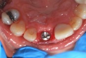 Dental Function Repair - Comprehensive tooth replacement with Dental Implants