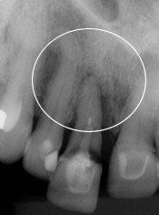 Tooth Falling Down - Contact our Fairport dentists for Dental Implant consult