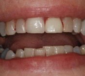 Fairport Dental Implant Flipper - Free dental consultation