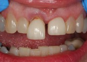 Supererupted Malocclusion Photo - Find out how Fairport Dental Implants can help