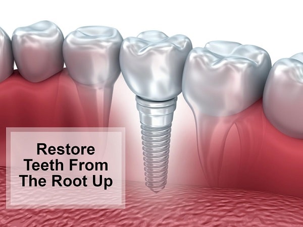Dental implants to restore your teeth