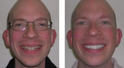 Shawn Before After Photo - Brighton Cosmetic Dentistry
