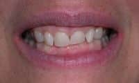 Before closeup photo gummy smile - Laser Cosmetic treatment