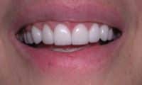 Gummy smile reconstruction after photo - Fairport Porcelain Veneers