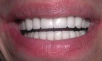 After Image: Empress Crown – Veneer Reconstruction - front