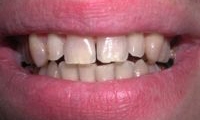 Before Image: Empress Crown – Veneer Reconstruction - front