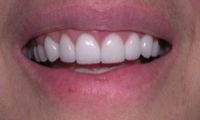 After Image: Empress Porcelain Veneer Treatment - front