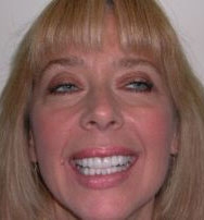 After Image: Empress Porcelain Veneer Treatment - front
