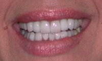 After Image: Empress Porcelain Veneer Treatment - front