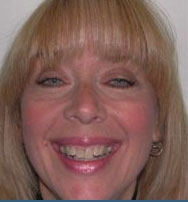 Before Image: Empress Porcelain Veneer Treatment - front