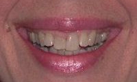 Before Image: Empress Porcelain Veneer Treatment - front