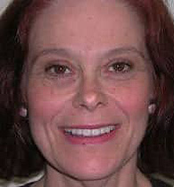 After Image: Empress Porcelain Veneers Smile Makeover - front
