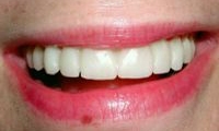 After Image: Empress Porcelain Veneers Smile Makeover - front