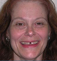 Before Image: Empress Porcelain Veneers Smile Makeover - front